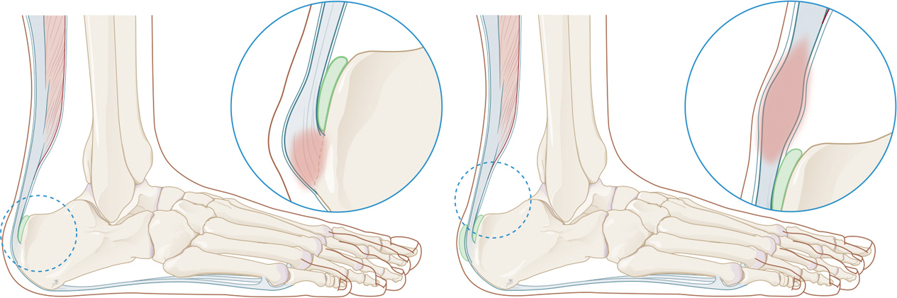 Pijnlijke achillespees Pijnlijke achillespees