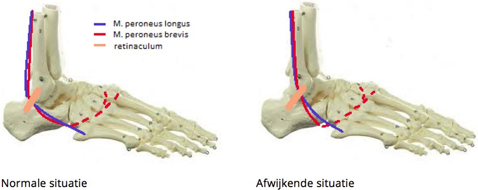 Afwijking van de botstructuur Afwijking van de botstructuur