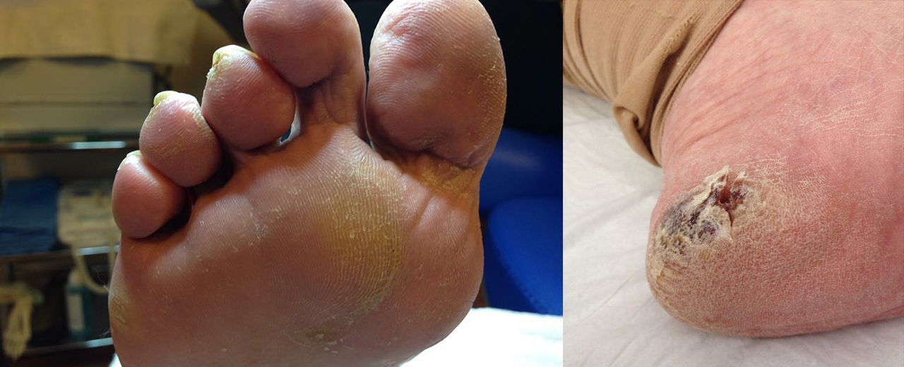 Pijn door eelt onder de voet Pijn door eelt onder de voet