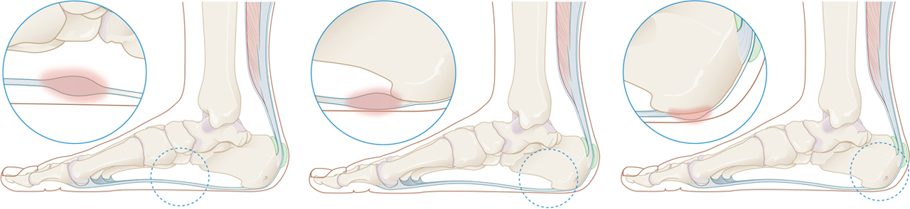 Peesplaatontsteking Peesplaatontsteking