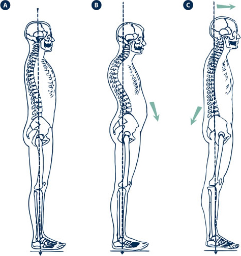 Houding bij holvoeten en platvoeten Houding bij holvoeten en platvoeten