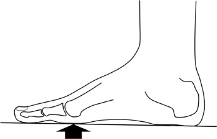 Metatarsalgie: pijn onder de voorvoet Metatarsalgie: pijn onder de voorvoet