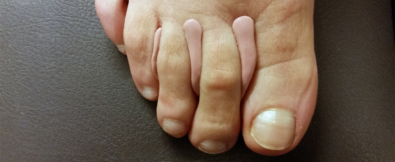 Helpt een siliconen-orthese bij voetklachten? Helpt een siliconen-orthese bij voetklachten?